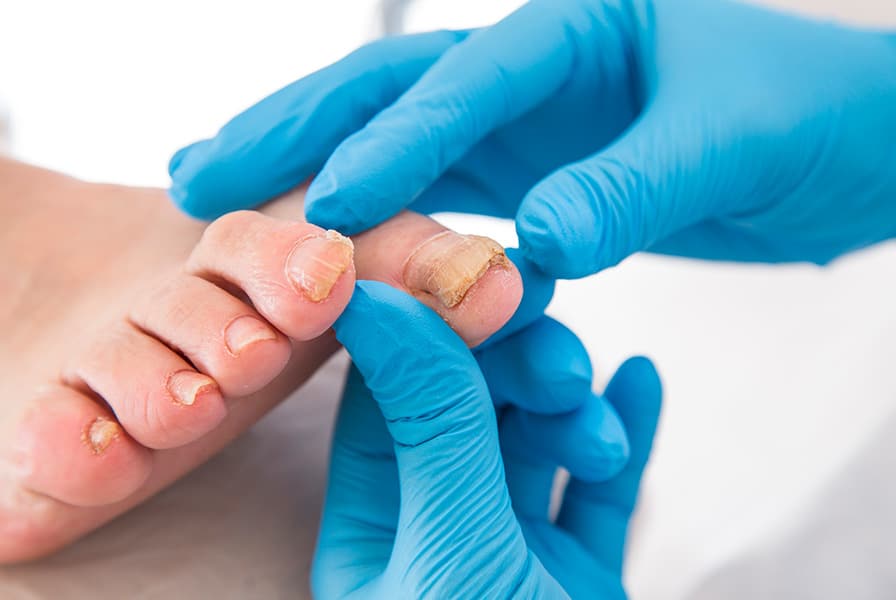 Toenail Toenail Method Ingrown Nail Treatment & Removal for West Valley City & Orem