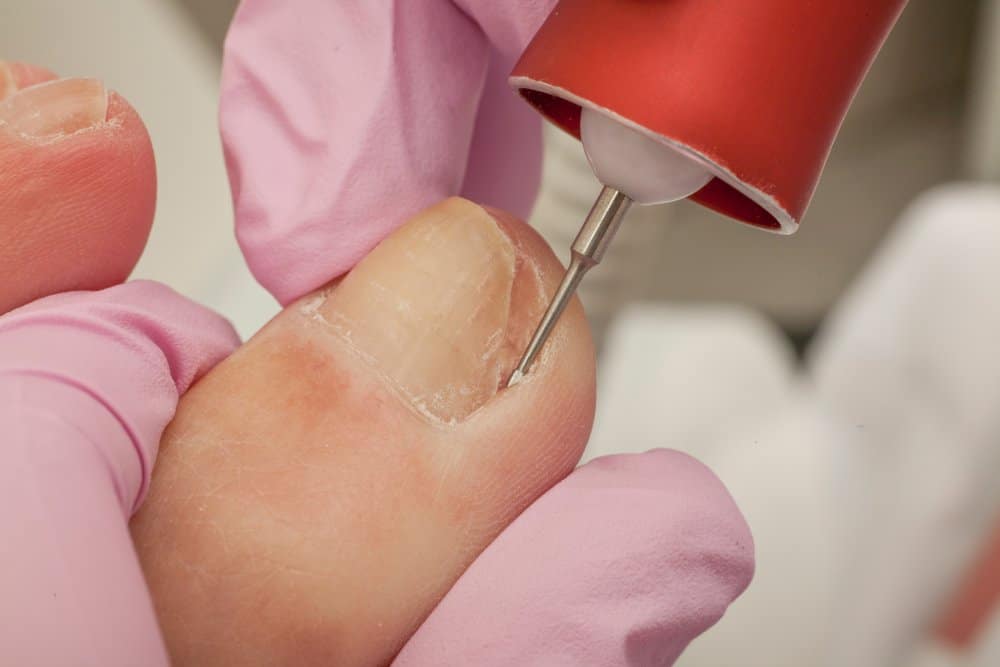 Ingrown toenail treatments