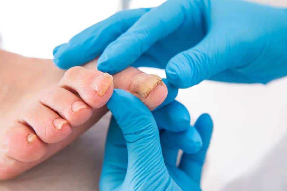Ingrown toenail treatment