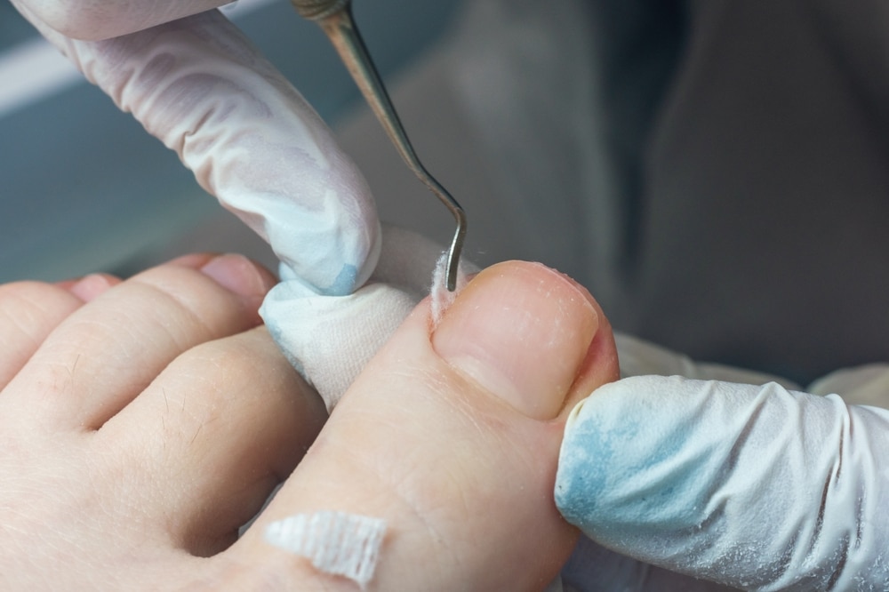 ingrown toenail risks