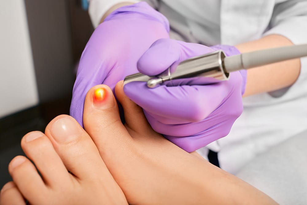 laser vs topical toenail fungus remedies