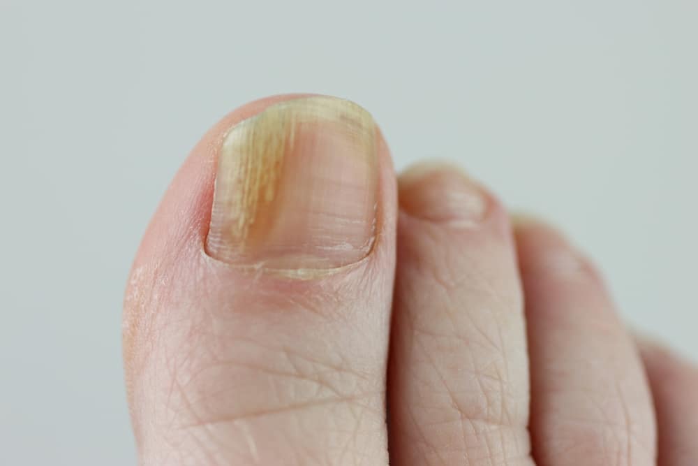 toenail fungus early signs